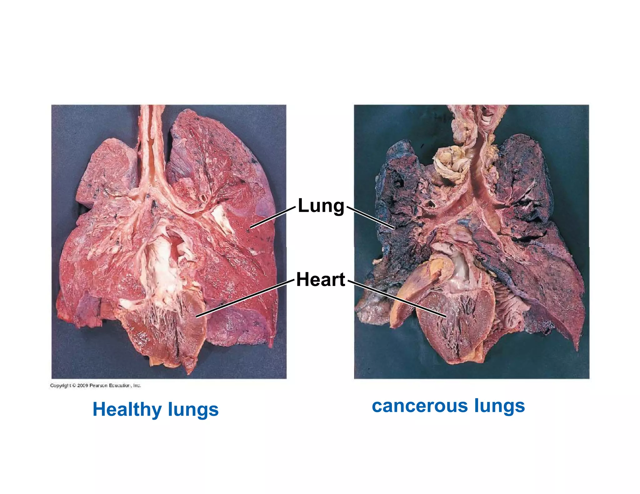 Lung 
Heart 
Healthy lungs cancerous lungs 
 