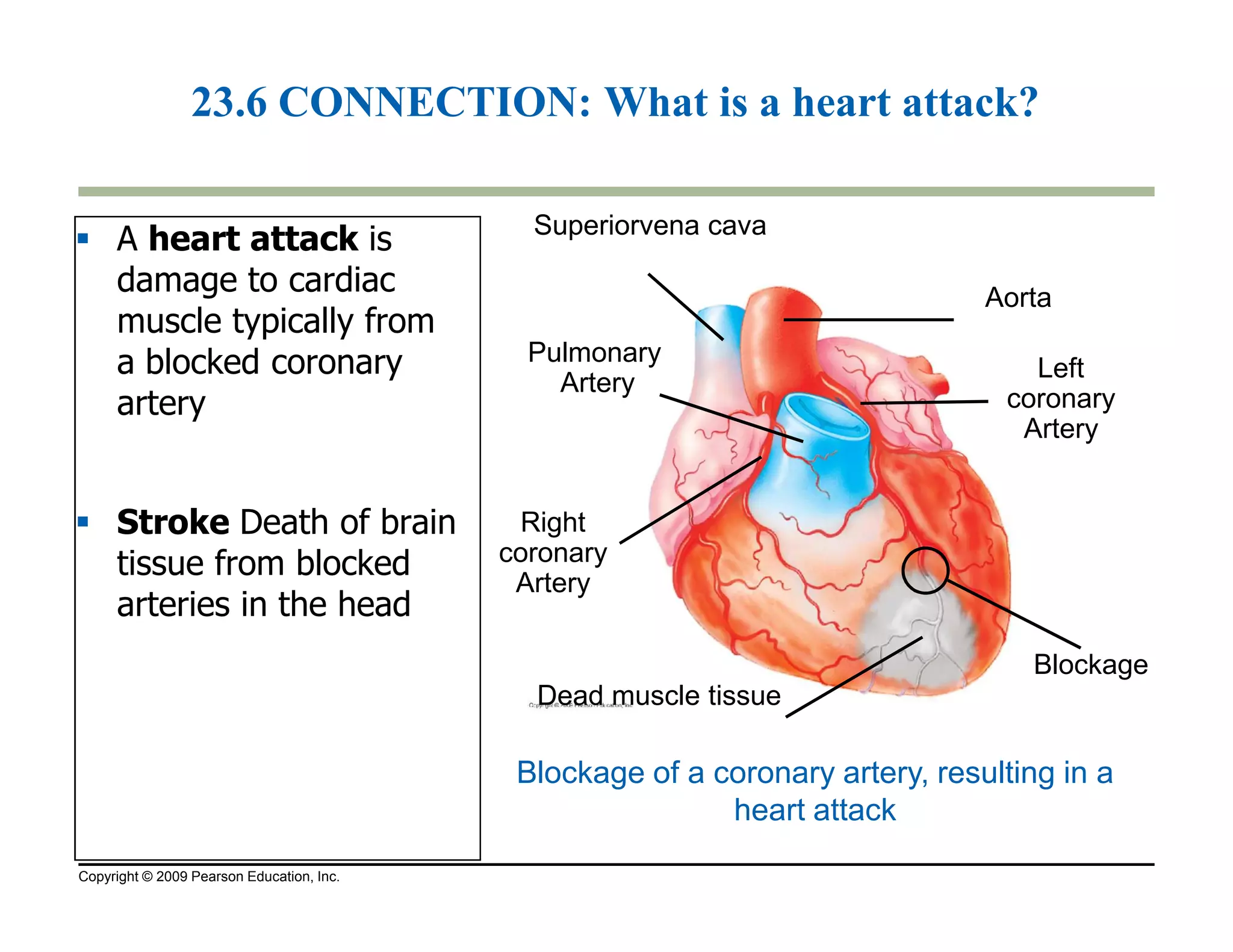 23.6 CONNECTION: What is a heart attack? 
 A heart attack is 
damage to cardiac 
muscle typically from 
a blocked coronary 
artery 
Superiorvena cava 
Pulmonary 
Artery 
Aorta 
Left 
coronary 
Artery 
 Stroke Death of brain 
tissue from blocked 
arteries in the head 
Copyright © 2009 Pearson Education, Inc. 
Right 
coronary 
Artery 
Blockage 
Dead muscle tissue 
Blockage of a coronary artery, resulting in a 
heart attack 
 