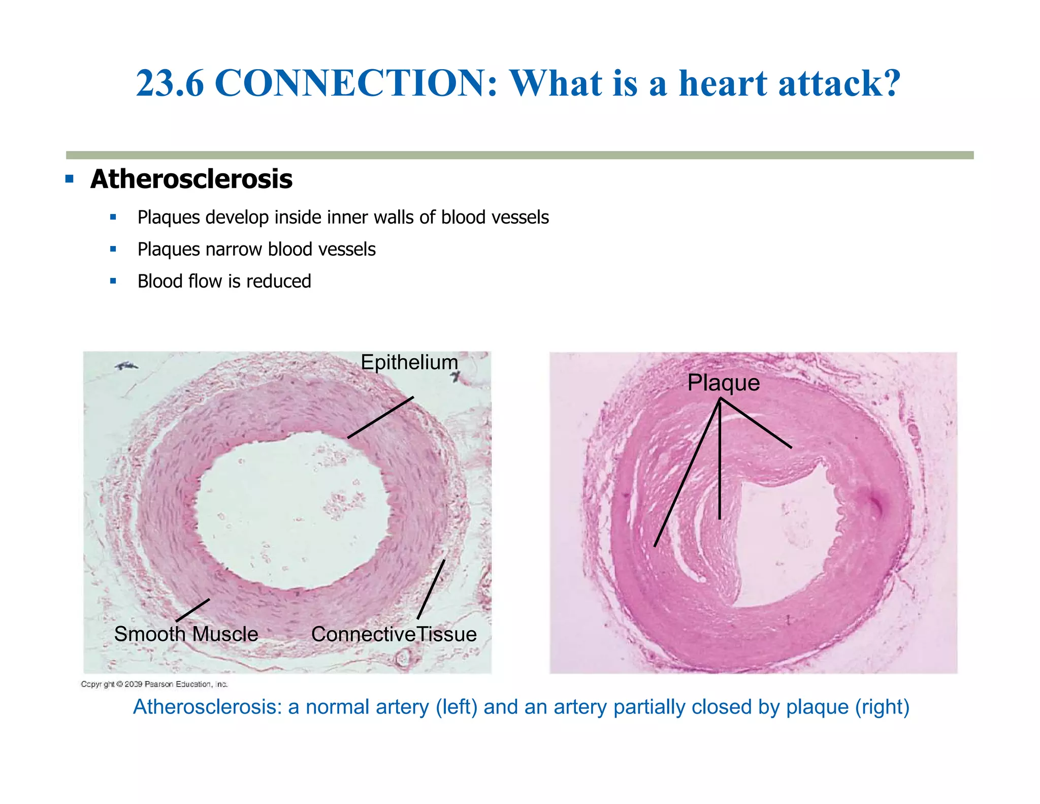 23.6 CONNECTION: What is a heart attack? 
Plaque 
Epithelium 
 Atherosclerosis 
 Plaques develop inside inner walls of blood vessels 
 Plaques narrow blood vessels 
 Blood flow is reduced 
Smooth Muscle ConnectiveTissue 
Atherosclerosis: a normal artery (left) and an artery partially closed by plaque (right) 
 