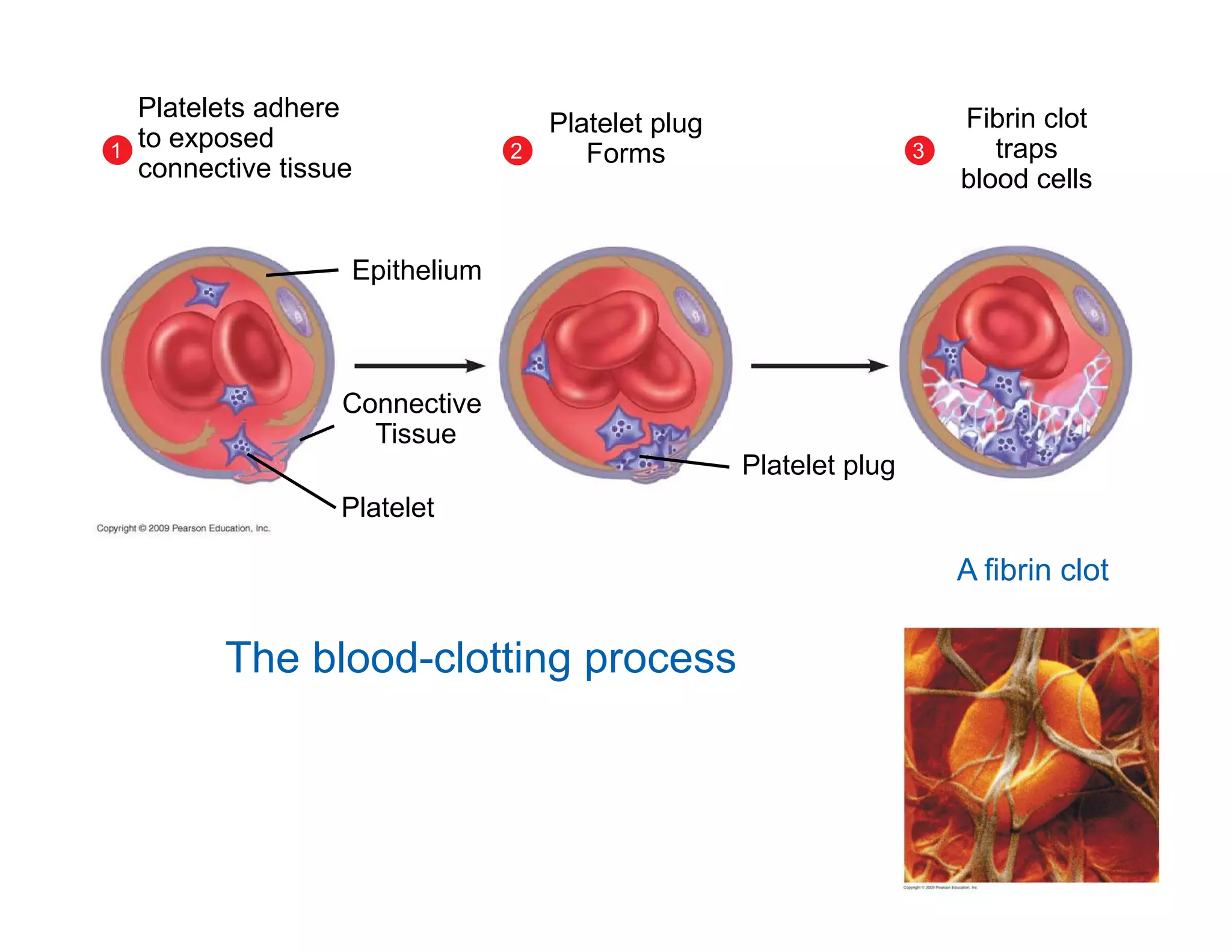 1 2 
Fibrin clot 
traps 
blood cells 
3 
Platelet plug 
Forms 
Platelet plug 
Platelets adhere 
to exposed 
connective tissue 
Epithelium 
Connective 
Tissue 
Platelet 
The blood-clotting process 
A fibrin clot 
 