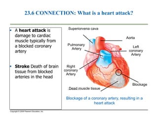 23.6 CONNECTION: What is a heart attack? 
 A heart attack is 
damage to cardiac 
muscle typically from 
a blocked coronary 
artery 
Superiorvena cava 
Pulmonary 
Artery 
Aorta 
Left 
coronary 
Artery 
 Stroke Death of brain 
tissue from blocked 
arteries in the head 
Copyright © 2009 Pearson Education, Inc. 
Right 
coronary 
Artery 
Blockage 
Dead muscle tissue 
Blockage of a coronary artery, resulting in a 
heart attack 
 