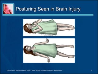 Posturing Seen in Brain InjuryPosturing Seen in Brain Injury
74Elsevier items and derived items © 2011, 2007, 2006 by Saunders, an imprint of Elsevier Inc.
 