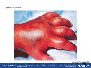 Prehospital Emergency Care, 10th
edition
Mistovich | Karren
Copyright © 2014, 2010, 2008 by Pearson Education, Inc.
All Rights Reserved
Snakebite to the hand.
continued on next slide
 