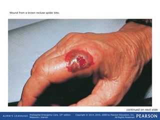 Prehospital Emergency Care, 10th
edition
Mistovich | Karren
Copyright © 2014, 2010, 2008 by Pearson Education, Inc.
All Rights Reserved
Wound from a brown recluse spider bite.
continued on next slide
 