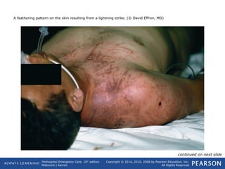 Prehospital Emergency Care, 10th
edition
Mistovich | Karren
Copyright © 2014, 2010, 2008 by Pearson Education, Inc.
All Rights Reserved
A feathering pattern on the skin resulting from a lightning strike. (© David Effron, MD)
continued on next slide
 