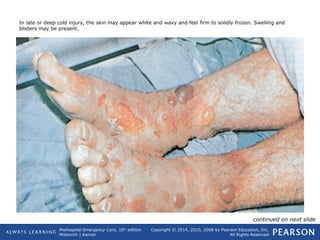 Prehospital Emergency Care, 10th
edition
Mistovich | Karren
Copyright © 2014, 2010, 2008 by Pearson Education, Inc.
All Rights Reserved
In late or deep cold injury, the skin may appear white and waxy and feel firm to solidly frozen. Swelling and
blisters may be present.
continued on next slide
 