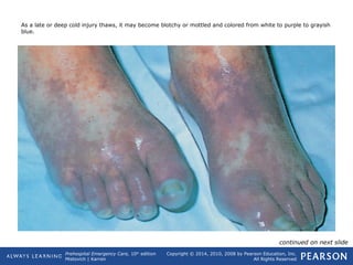 Prehospital Emergency Care, 10th
edition
Mistovich | Karren
Copyright © 2014, 2010, 2008 by Pearson Education, Inc.
All Rights Reserved
As a late or deep cold injury thaws, it may become blotchy or mottled and colored from white to purple to grayish
blue.
continued on next slide
 
