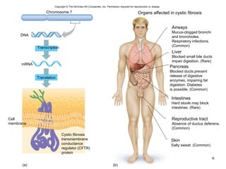 Chromosome 7 (a) Organs affected in cystic fibrosis (b) Transcription Translation Cell membrane DNA mRNA Cystic fibrosis transmembrane conductance regulator (CFTR) protein Airways Mucus-clogged bronchi and bronchioles. Respiratory infections. (Common) Liver Blocked small bile ducts impair digestion. (Rare) Pancreas Blocked ducts prevent release of digestive enzymes, impairing fat digestion. Diabetes is possible. (Common) Intestines Hard stools may block intestines. (Rare) Reproductive tract Absence of ductus deferens. (Common) Skin Salty sweat. (Common) Copyright © The McGraw-Hill Companies, Inc. Permission required for reproduction or display. 