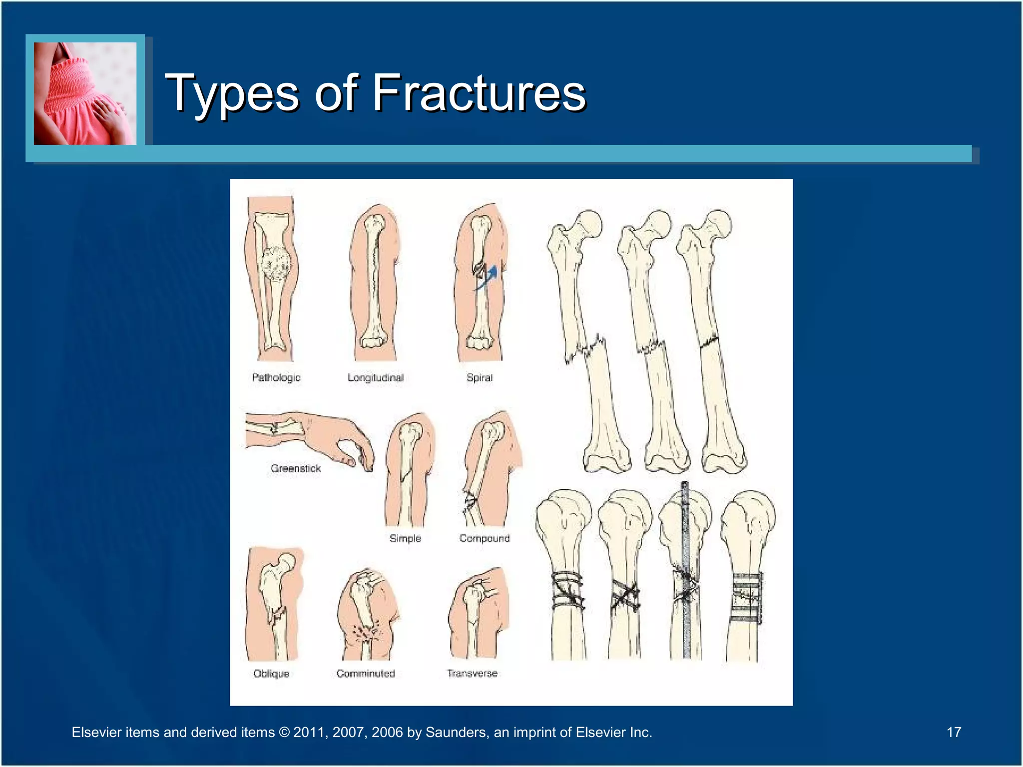 Types of FracturesTypes of Fractures
17Elsevier items and derived items © 2011, 2007, 2006 by Saunders, an imprint of Elsevier Inc.
 