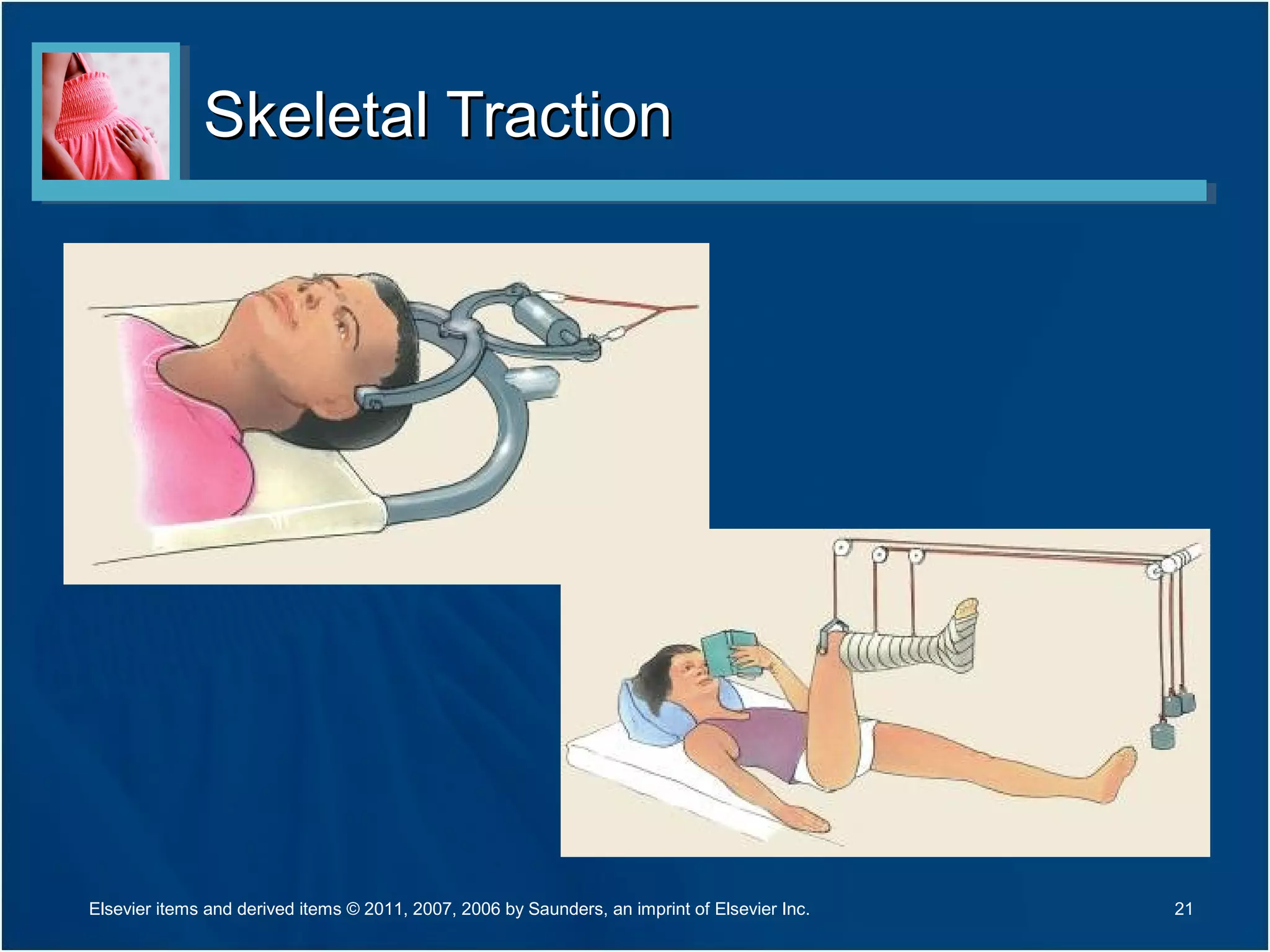 Skeletal TractionSkeletal Traction
21Elsevier items and derived items © 2011, 2007, 2006 by Saunders, an imprint of Elsevier Inc.
 