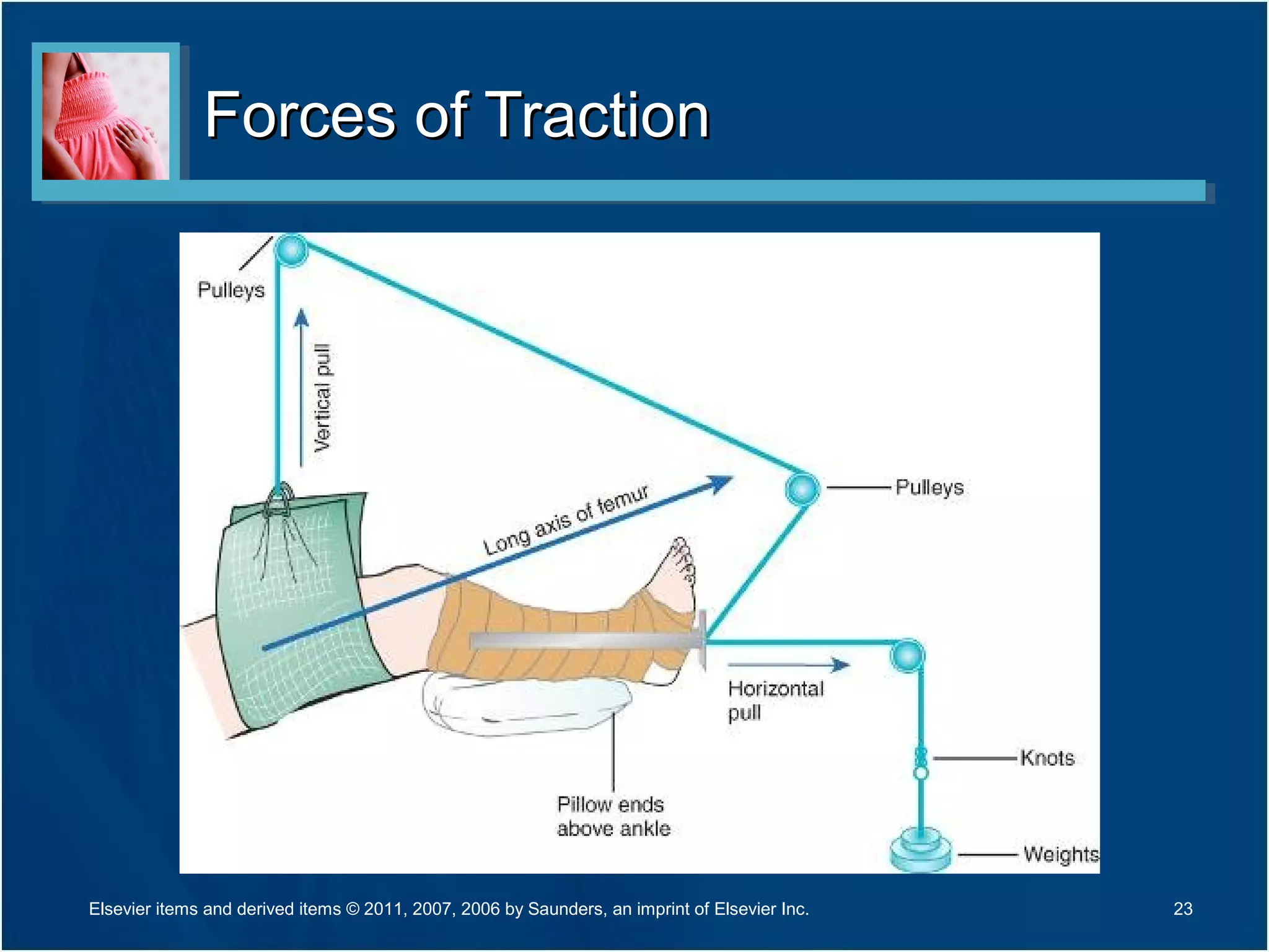 Forces of TractionForces of Traction
23Elsevier items and derived items © 2011, 2007, 2006 by Saunders, an imprint of Elsevier Inc.
 