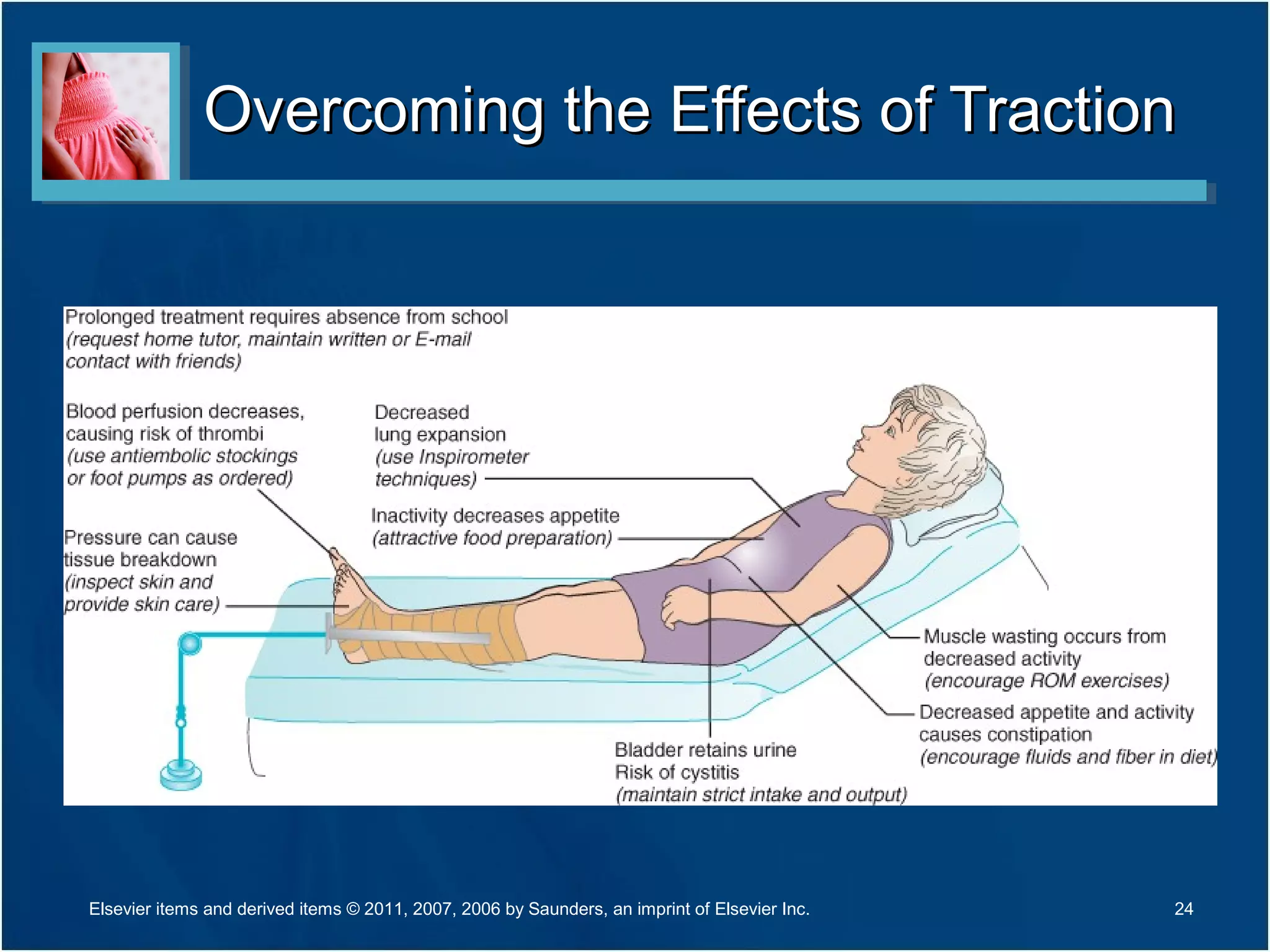 Overcoming the Effects of TractionOvercoming the Effects of Traction
24Elsevier items and derived items © 2011, 2007, 2006 by Saunders, an imprint of Elsevier Inc.
 