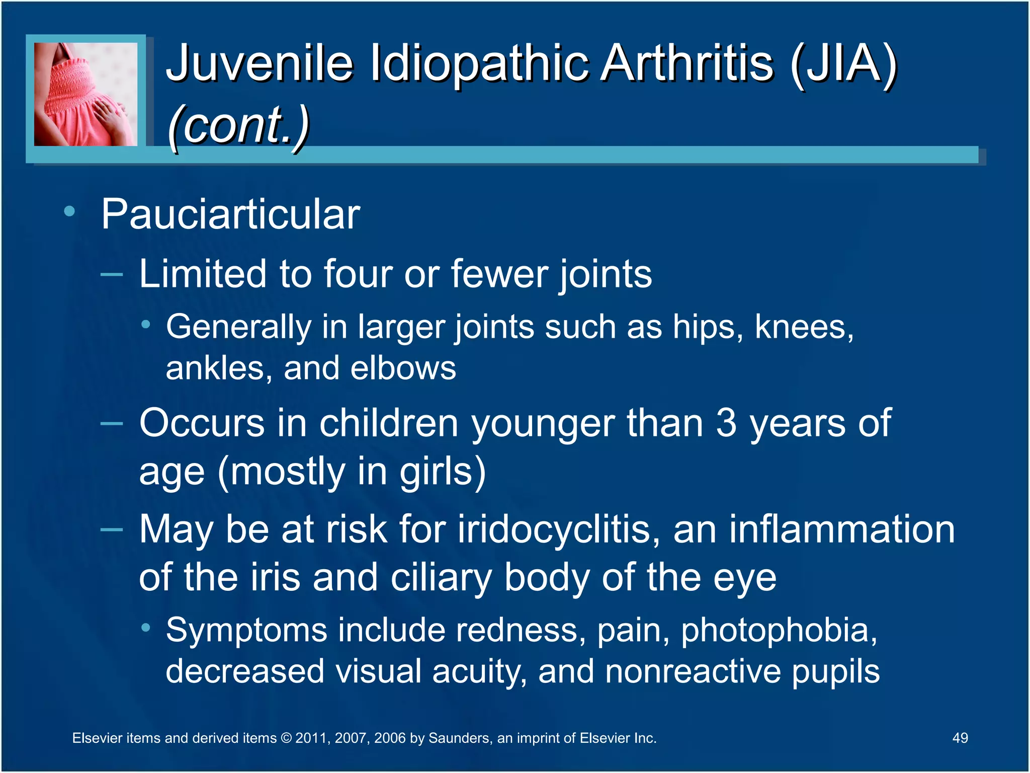 Juvenile Idiopathic Arthritis (JIA)Juvenile Idiopathic Arthritis (JIA)
(cont.)(cont.)
• Pauciarticular
– Limited to four or fewer joints
• Generally in larger joints such as hips, knees,
ankles, and elbows
– Occurs in children younger than 3 years of
age (mostly in girls)
– May be at risk for iridocyclitis, an inflammation
of the iris and ciliary body of the eye
• Symptoms include redness, pain, photophobia,
decreased visual acuity, and nonreactive pupils
49Elsevier items and derived items © 2011, 2007, 2006 by Saunders, an imprint of Elsevier Inc.
 