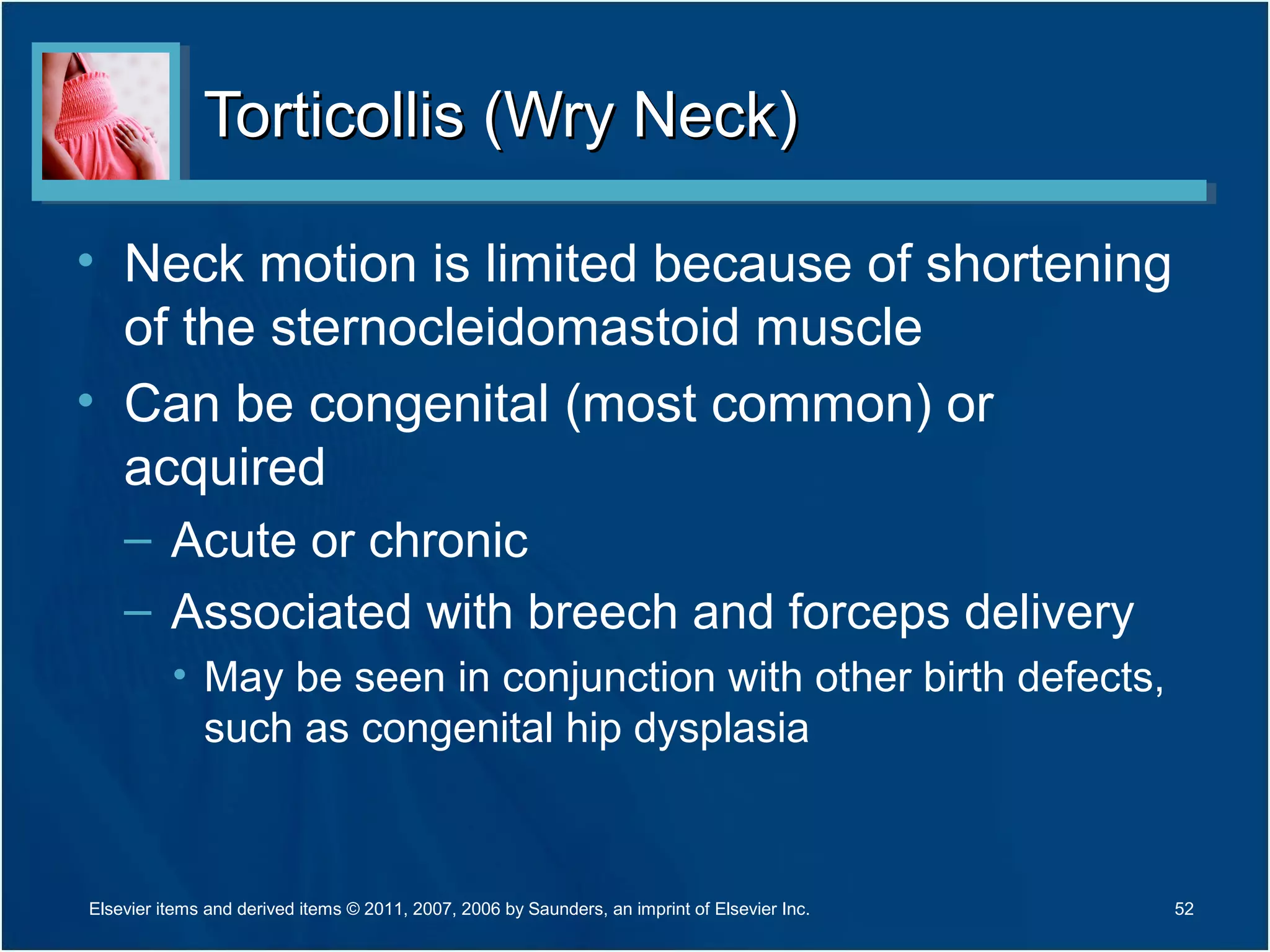Torticollis (Wry Neck)Torticollis (Wry Neck)
• Neck motion is limited because of shortening
of the sternocleidomastoid muscle
• Can be congenital (most common) or
acquired
– Acute or chronic
– Associated with breech and forceps delivery
• May be seen in conjunction with other birth defects,
such as congenital hip dysplasia
52Elsevier items and derived items © 2011, 2007, 2006 by Saunders, an imprint of Elsevier Inc.
 