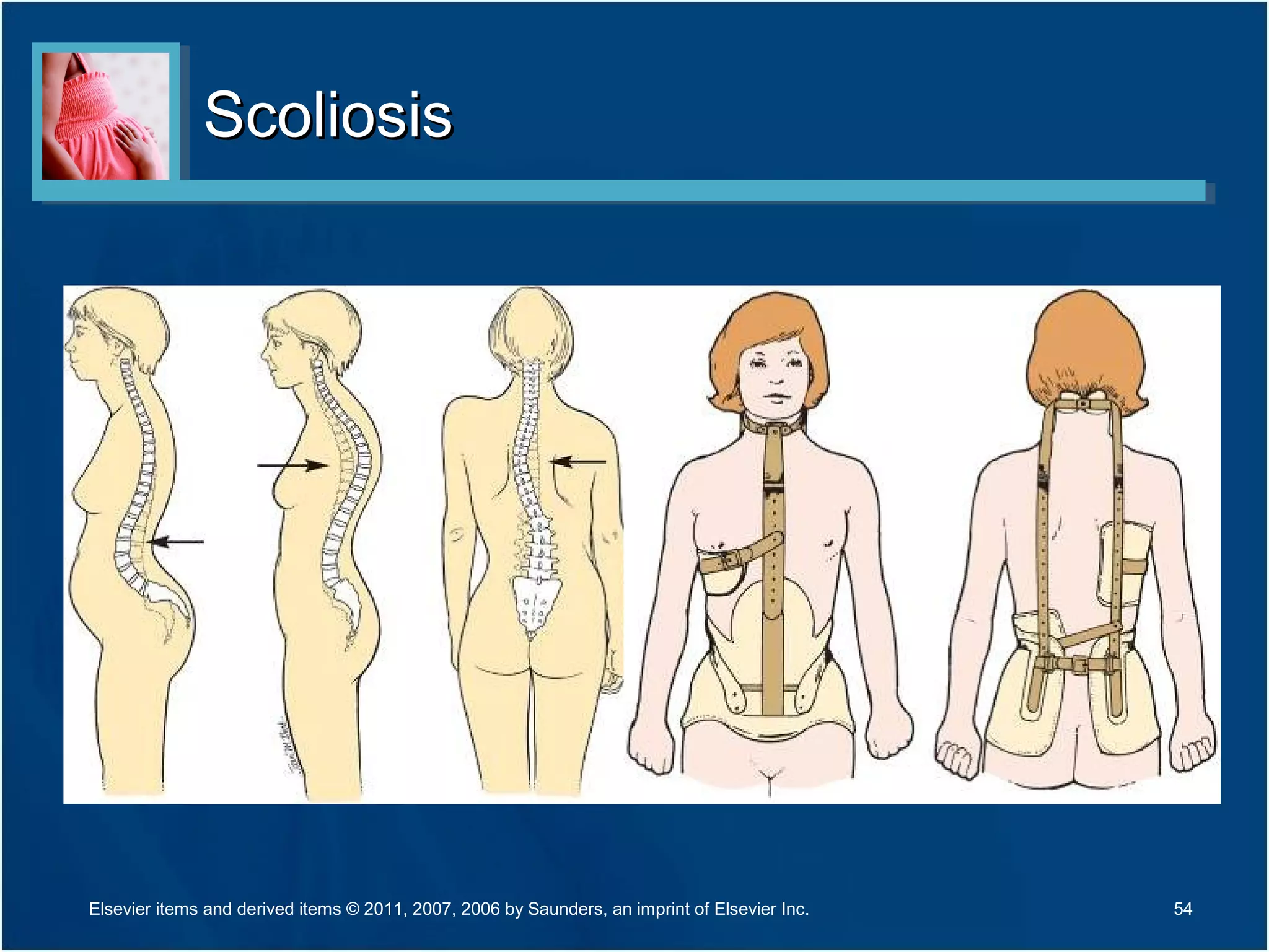 ScoliosisScoliosis
54Elsevier items and derived items © 2011, 2007, 2006 by Saunders, an imprint of Elsevier Inc.
 