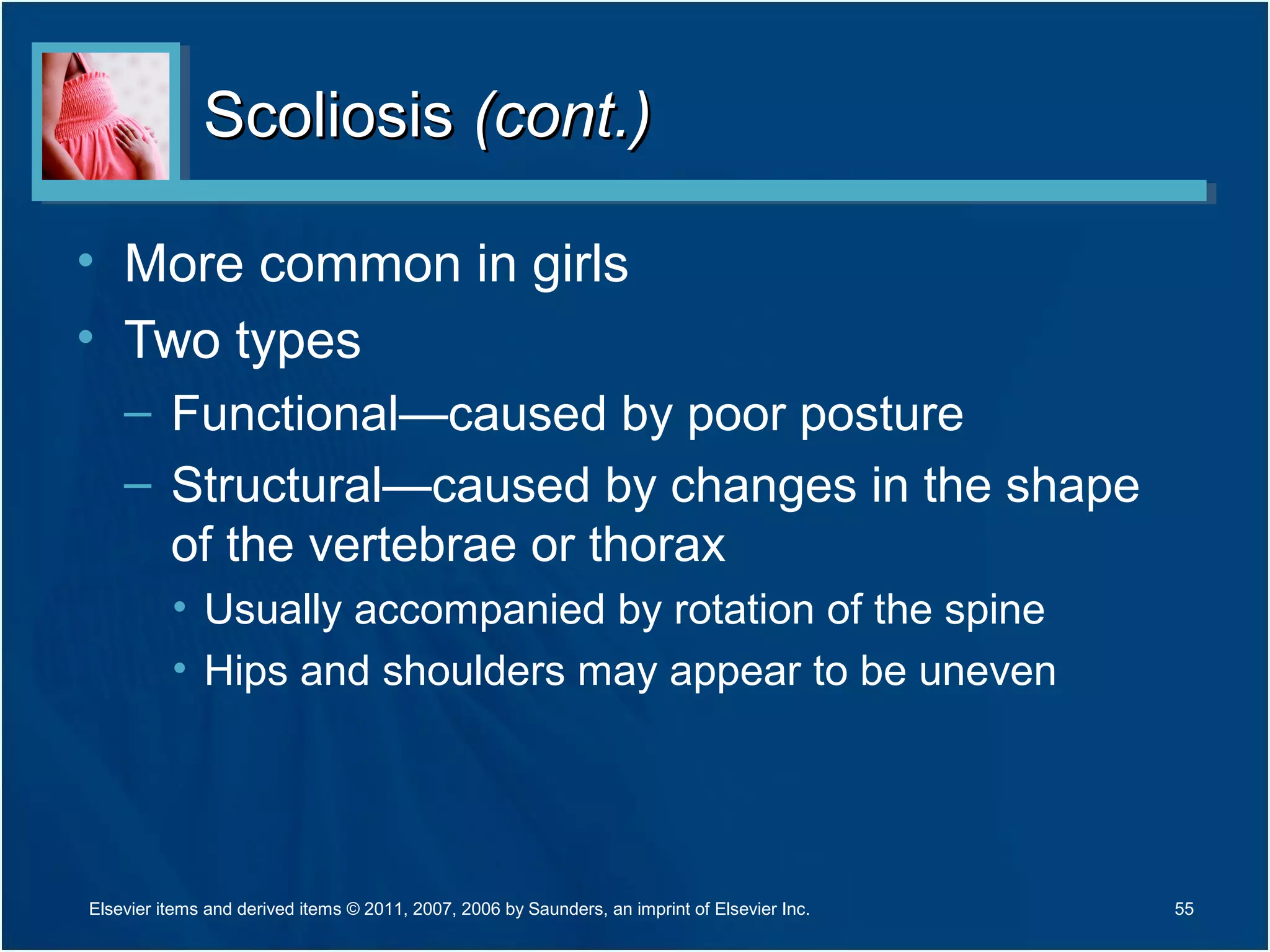 ScoliosisScoliosis (cont.)(cont.)
• More common in girls
• Two types
– Functional—caused by poor posture
– Structural—caused by changes in the shape
of the vertebrae or thorax
• Usually accompanied by rotation of the spine
• Hips and shoulders may appear to be uneven
55Elsevier items and derived items © 2011, 2007, 2006 by Saunders, an imprint of Elsevier Inc.
 