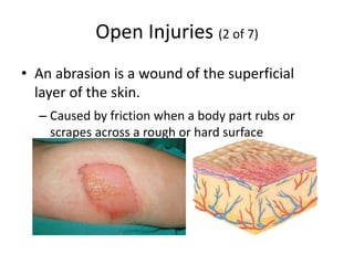 Open Injuries (2 of 7)
• An abrasion is a wound of the superficial
layer of the skin.
– Caused by friction when a body part rubs or
scrapes across a rough or hard surface
 