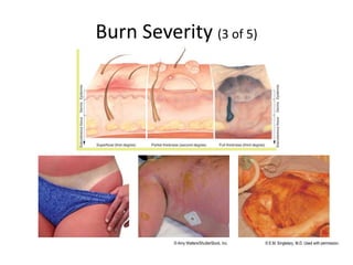 Burn Severity (3 of 5)
© Amy Walters/ShutterStock, Inc. © E.M. Singletary, M.D. Used with permission.
 