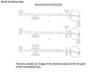 26.10  The Human Eye NEARSIGNTEDNESS The lens creates an image of the distance object at the far point of the nearsighted ...