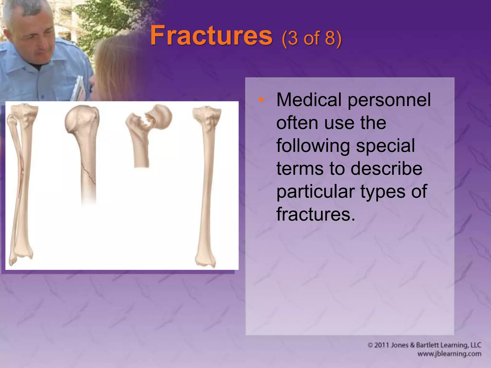 Fractures (3 of 8)
• Medical personnel
often use the
following special
terms to describe
particular types of
fractures.
 