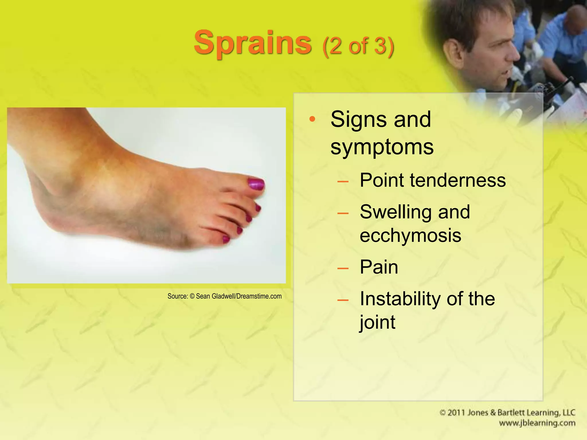 Sprains (2 of 3)
• Signs and
symptoms
– Point tenderness
– Swelling and
ecchymosis
– Pain
– Instability of the
joint
Source: © Sean Gladwell/Dreamstime.com
 