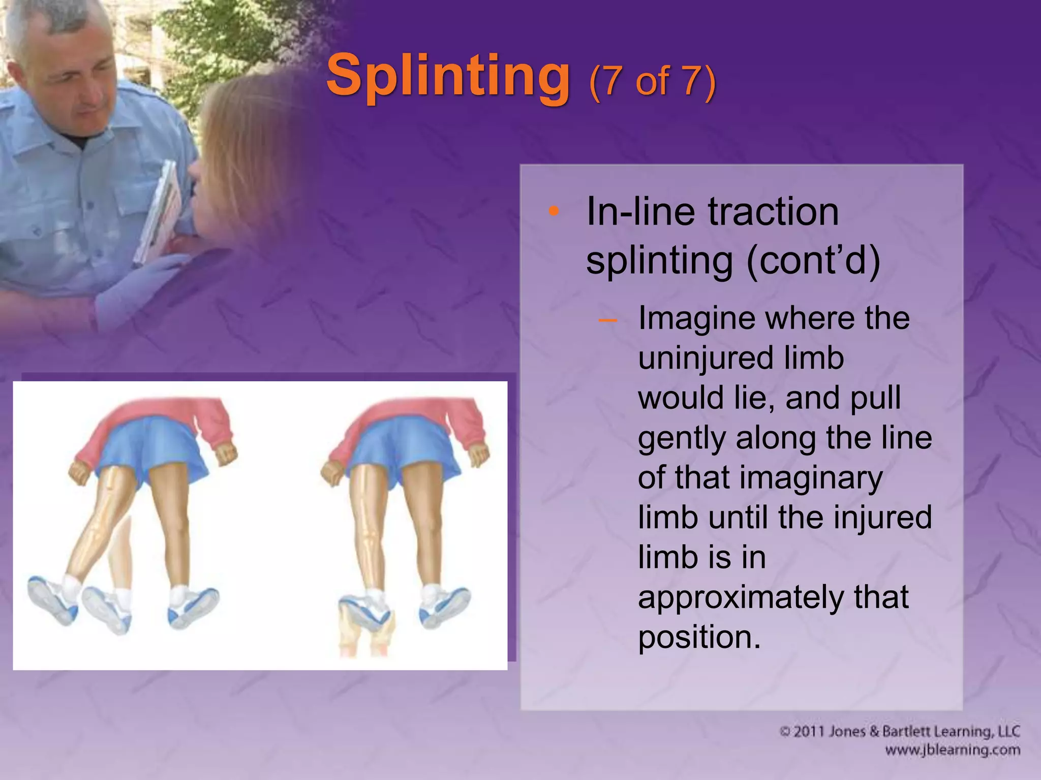 Splinting (7 of 7)
• In-line traction
splinting (cont’d)
– Imagine where the
uninjured limb
would lie, and pull
gently along the line
of that imaginary
limb until the injured
limb is in
approximately that
position.
 