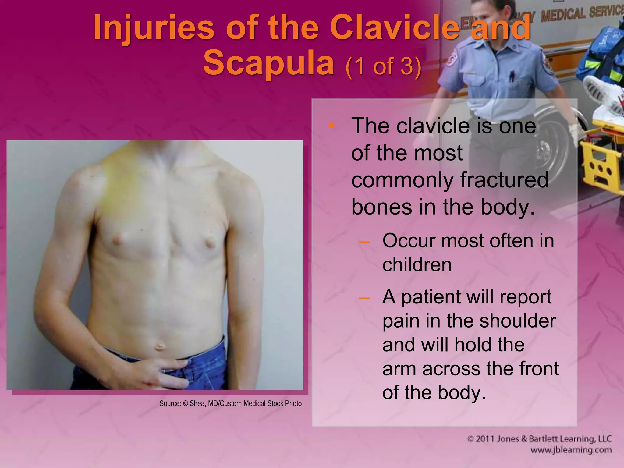 Injuries of the Clavicle and
Scapula (1 of 3)
• The clavicle is one
of the most
commonly fractured
bones in the body.
– Occur most often in
children
– A patient will report
pain in the shoulder
and will hold the
arm across the front
of the body.
Source: © Shea, MD/Custom Medical Stock Photo
 