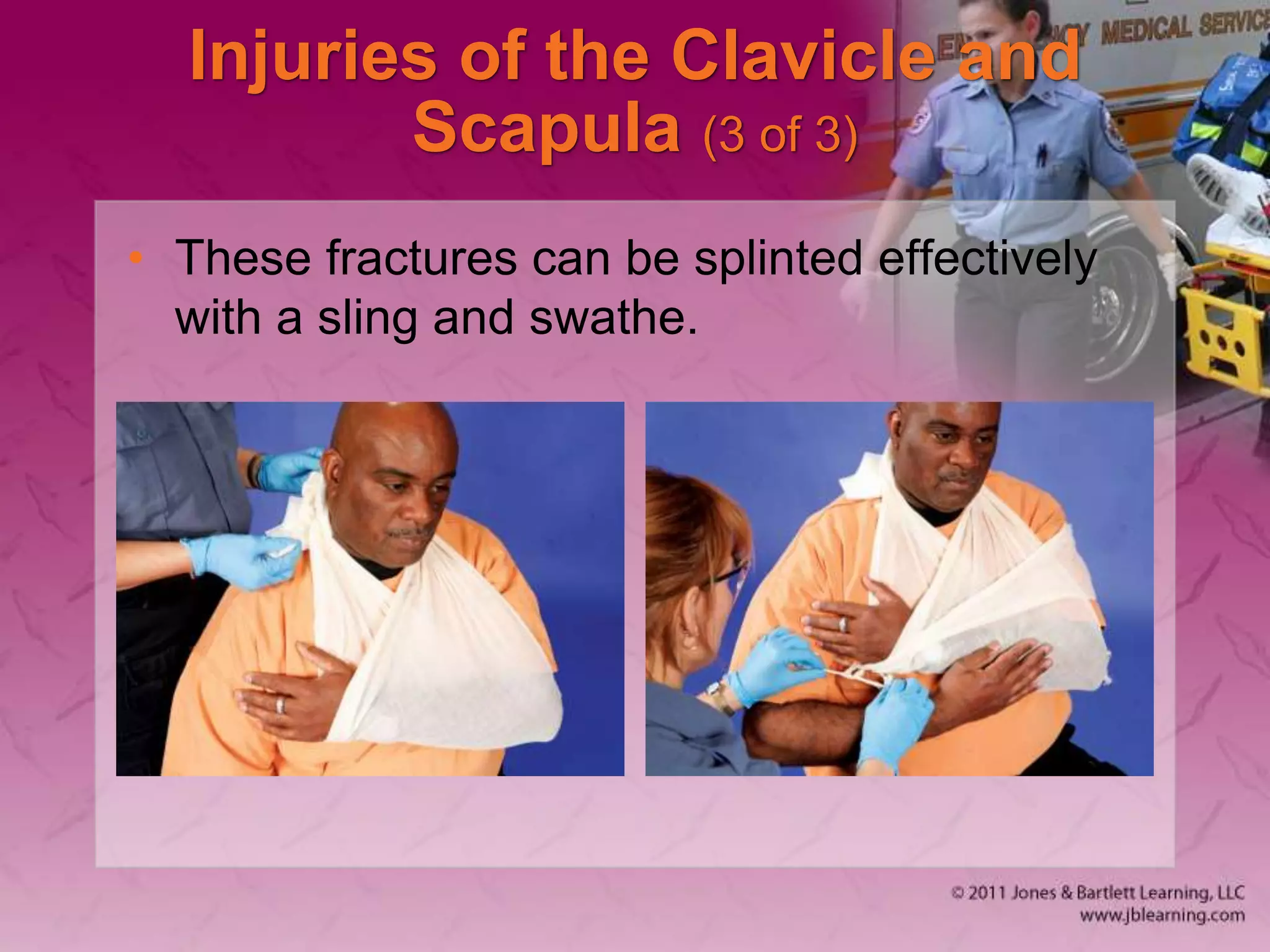 Injuries of the Clavicle and
Scapula (3 of 3)
• These fractures can be splinted effectively
with a sling and swathe.
 
