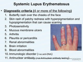 Systemic Lupus Erythematosus
• Diagnostic criteria (4 or more of the following)
1. Butterfly rash over the cheeks of the face
2. Skin rash of patchy redness with hyperpigmentation and
hypopigmentation that can cause scarring
3. Photosensitivity
4. Mucous membrane ulcers
5. Arthritis
6. Pleuritis or pericarditis
7. Renal abnormalities
8. Brain irritation
9. Blood abnormalities
10. Immunologic disorder (+ve anti-DNA)
11. Antinuclear antibody (+ve Antinuclear antibody testing) 32
 