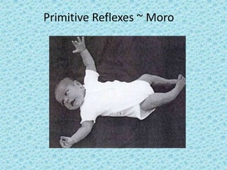 Primitive Reflexes ~ Moro
 
