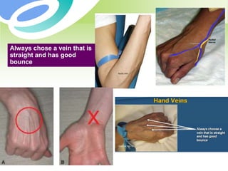 Always chose a vein that is
straight and has good
bounce
 