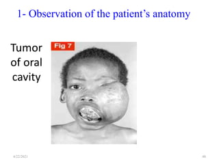 Tumor
of oral
cavity
48
1- Observation of the patient’s anatomy
4/22/2021
 
