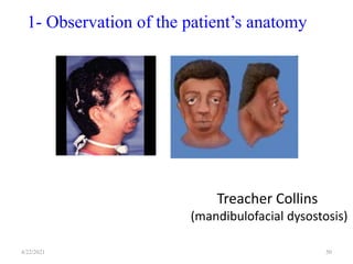 4/22/2021 50
Treacher Collins
(mandibulofacial dysostosis)
1- Observation of the patient’s anatomy
 
