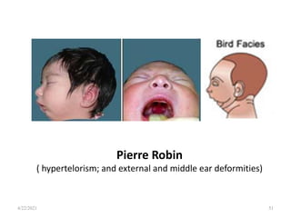 Pierre Robin
( hypertelorism; and external and middle ear deformities)
4/22/2021 51
 