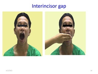 Interincisor gap
58
4/22/2021
 