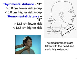 Thyromental distance – “A”
> 6.0 cm lower risk group
< 6.0 cm higher risk group
Sternomental distance –
“B”
> 12.5 cm lower risk
< 12.5 cm higher risk
59
The measurements are
taken with the head and
neck fully extended
 