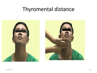 Thyromental distance
60
4/22/2021
 