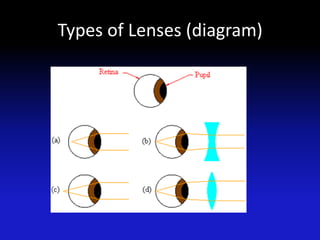 Types of Lenses (diagram)
 
