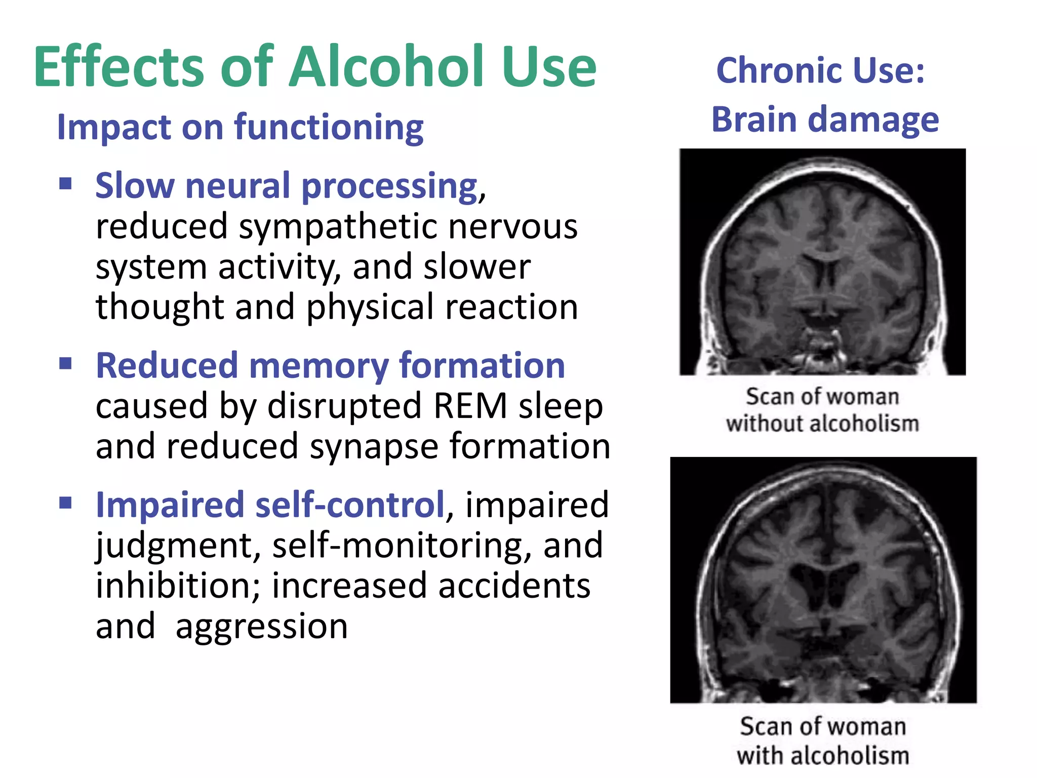 Effects of Alcohol Use
Impact on functioning
 Slow neural processing,
reduced sympathetic nervous
system activity, and slower
thought and physical reaction
 Reduced memory formation
caused by disrupted REM sleep
and reduced synapse formation
 Impaired self-control, impaired
judgment, self-monitoring, and
inhibition; increased accidents
and aggression
Chronic Use:
Brain damage
 