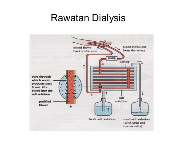 Como hacen las dialisis