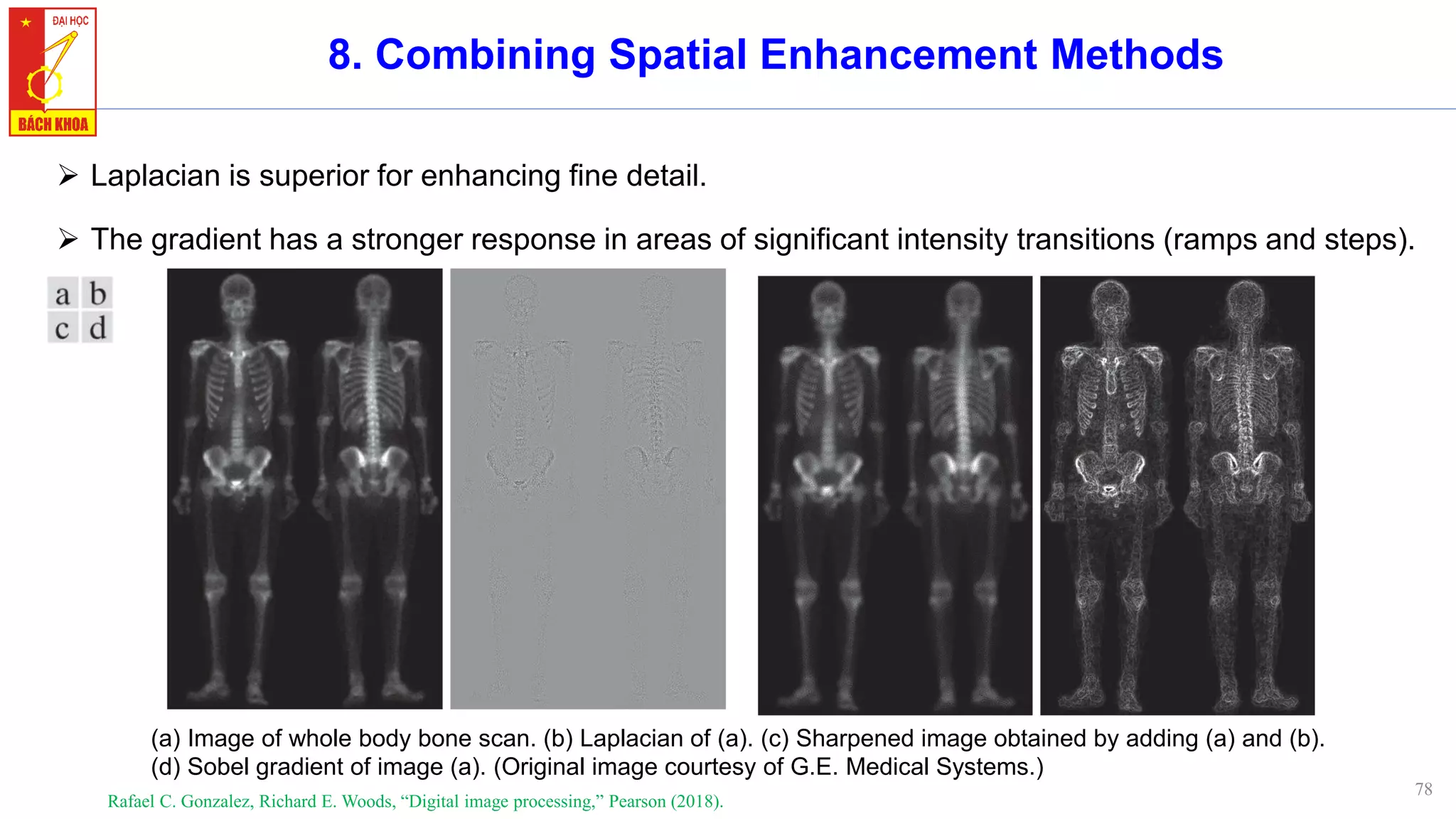 78
8. Combining Spatial Enhancement Methods
Rafael C. Gonzalez, Richard E. Woods, “Digital image processing,” Pearson (2018).
➢ Laplacian is superior for enhancing fine detail.
➢ The gradient has a stronger response in areas of significant intensity transitions (ramps and steps).
(a) Image of whole body bone scan. (b) Laplacian of (a). (c) Sharpened image obtained by adding (a) and (b).
(d) Sobel gradient of image (a). (Original image courtesy of G.E. Medical Systems.)
 