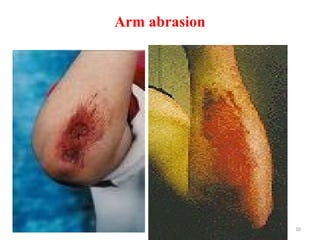 04/04/2025 10
Arm abrasion
 