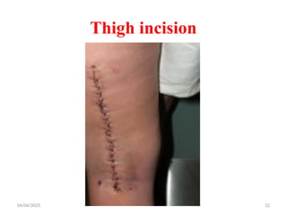 04/04/2025 12
Thigh incision
 