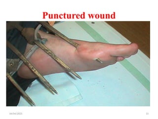 04/04/2025 15
Punctured wound
 