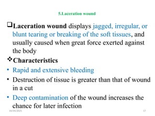 04/04/2025 17
5.Laceration wound
Laceration wound displays jagged, irregular, or
blunt tearing or breaking of the soft tissues, and
usually caused when great force exerted against
the body
Characteristics
• Rapid and extensive bleeding
• Destruction of tissue is greater than that of wound
in a cut
• Deep contamination of the wound increases the
chance for later infection
 