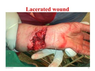 04/04/2025 18
Lacerated wound
 