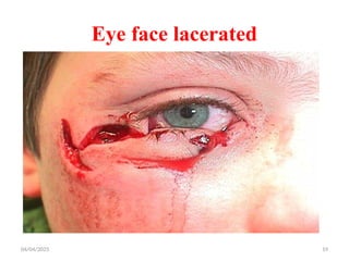 04/04/2025 19
Eye face lacerated
 