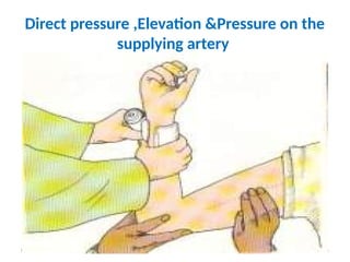 04/04/2025 45
Direct pressure ,Elevation &Pressure on the
supplying artery
 