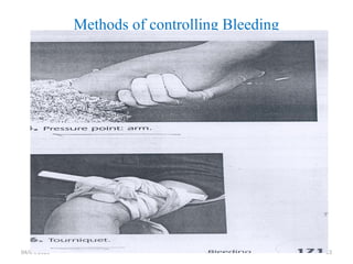 04/04/2025 53
Methods of controlling Bleeding
 