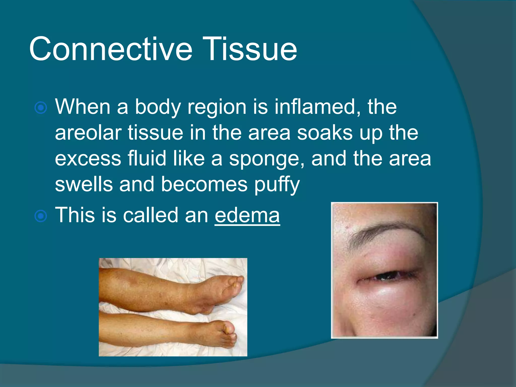 Connective Tissue
 When a body region is inflamed, the
areolar tissue in the area soaks up the
excess fluid like a sponge, and the area
swells and becomes puffy
 This is called an edema
 